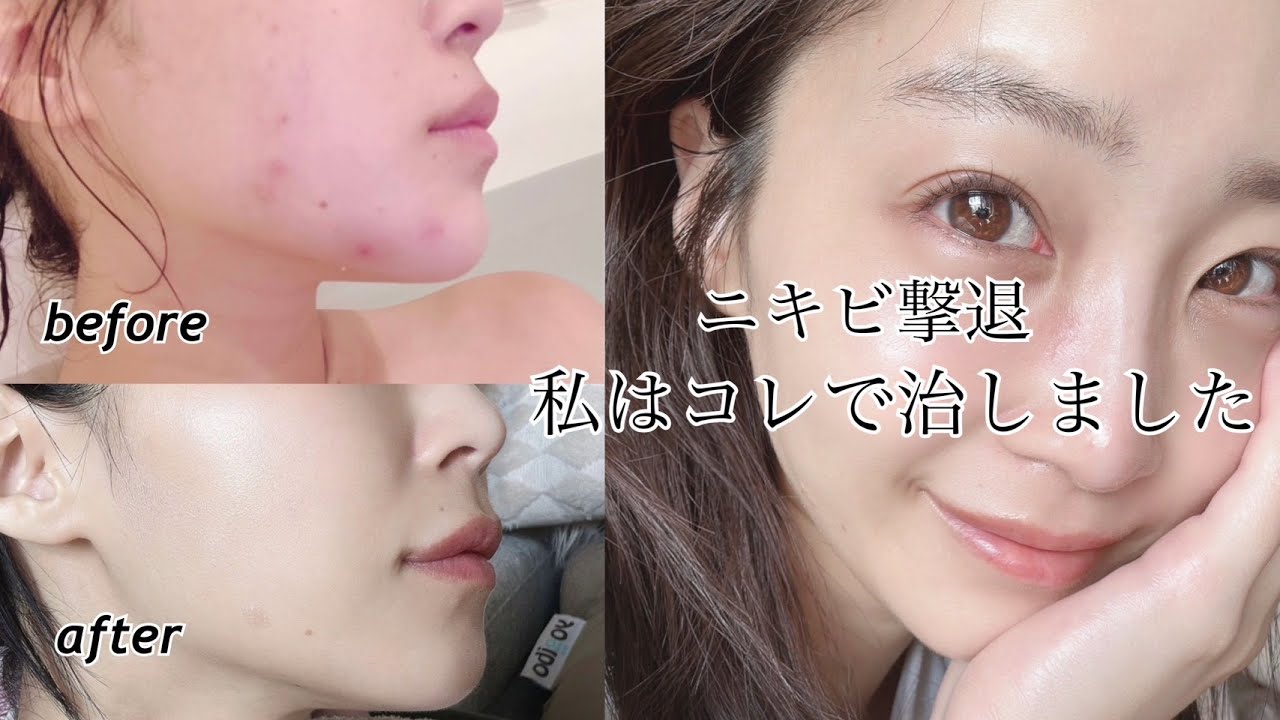 美容医療なし！ガチでやったおうちでできるニキビケア。