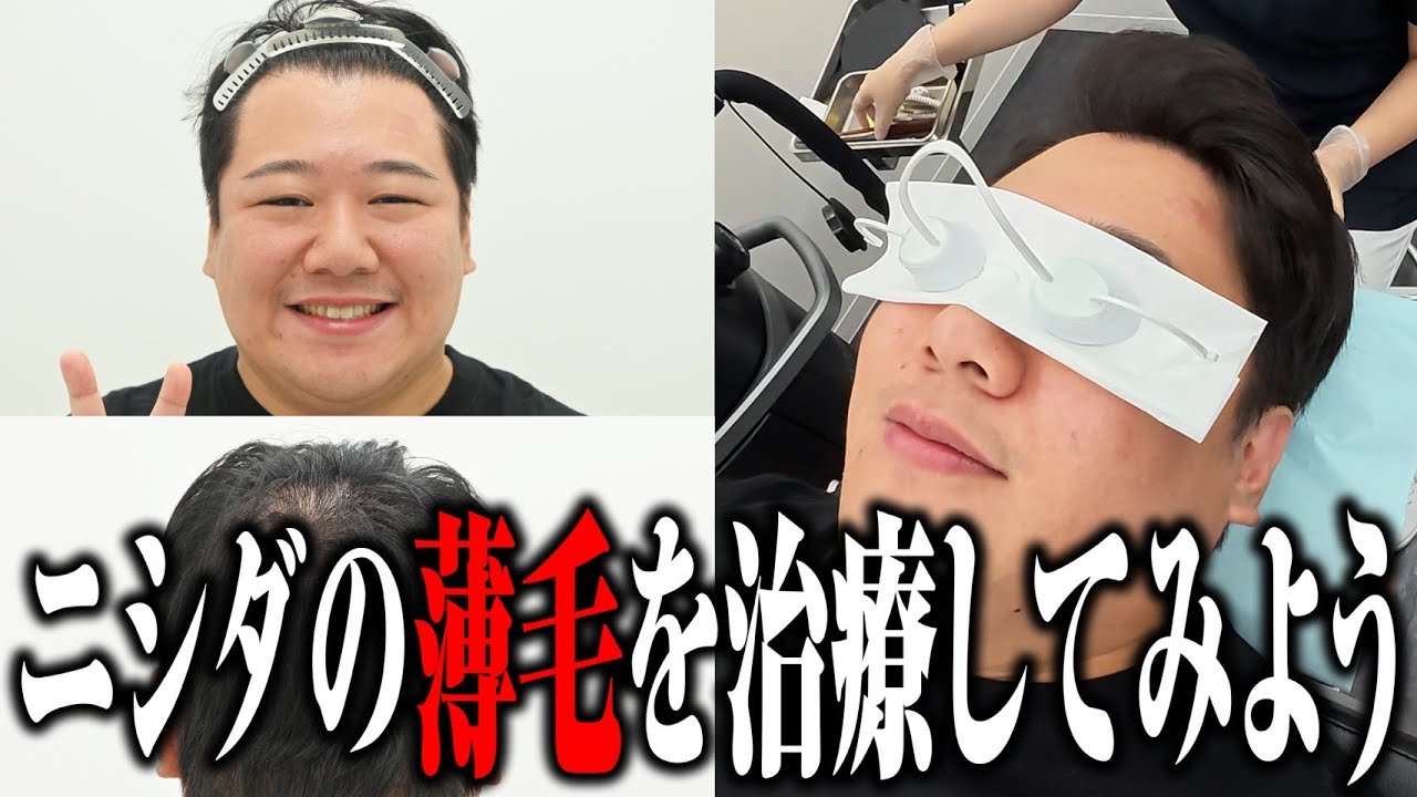 【ハゲ】ニシダの薄毛を治療してみよう