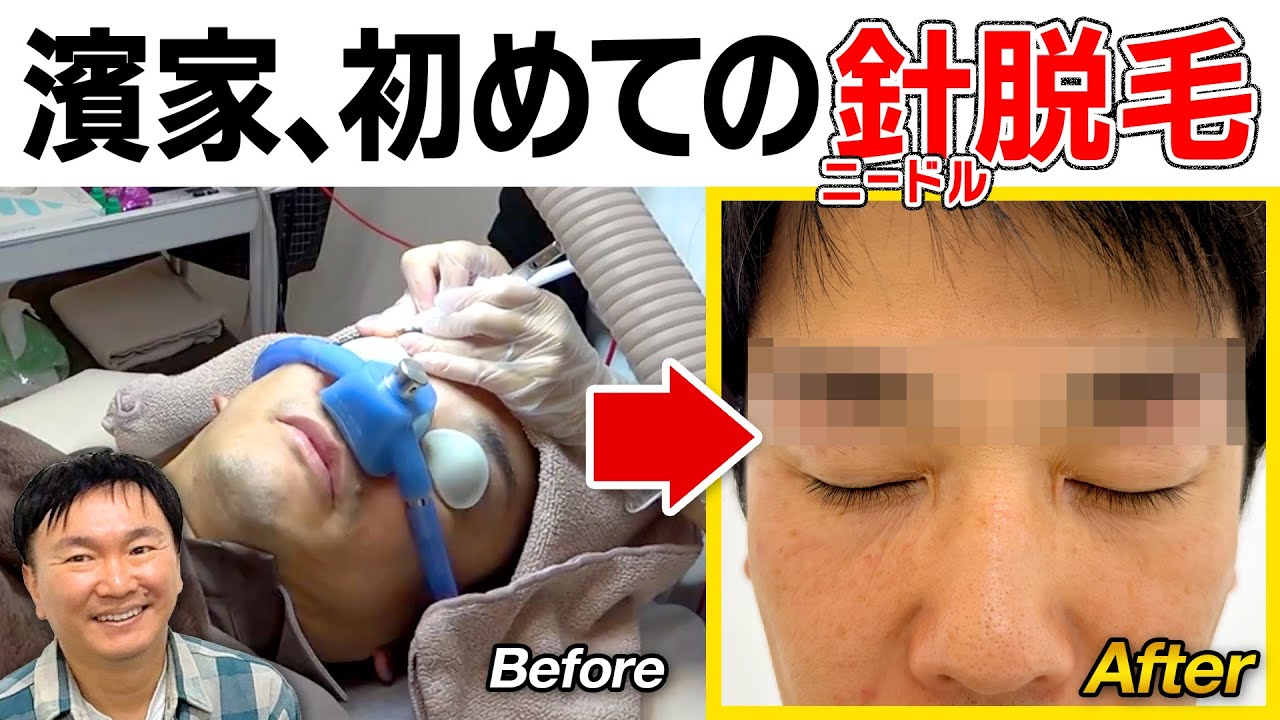 【針脱毛】かまいたち濱家が初めての針を使ったニードル脱毛体験！