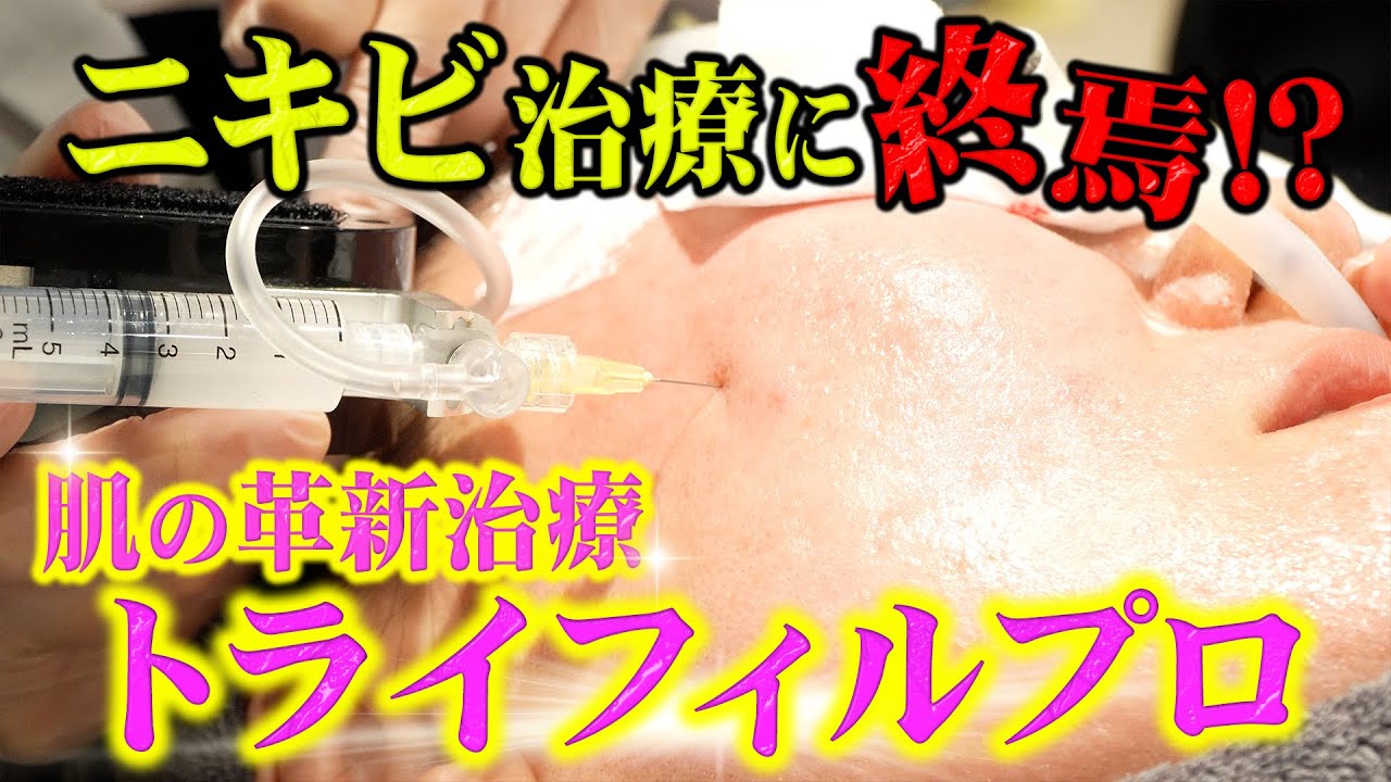 【ニキビ】クレーター治療終焉！？最短ルートはこれだ！！